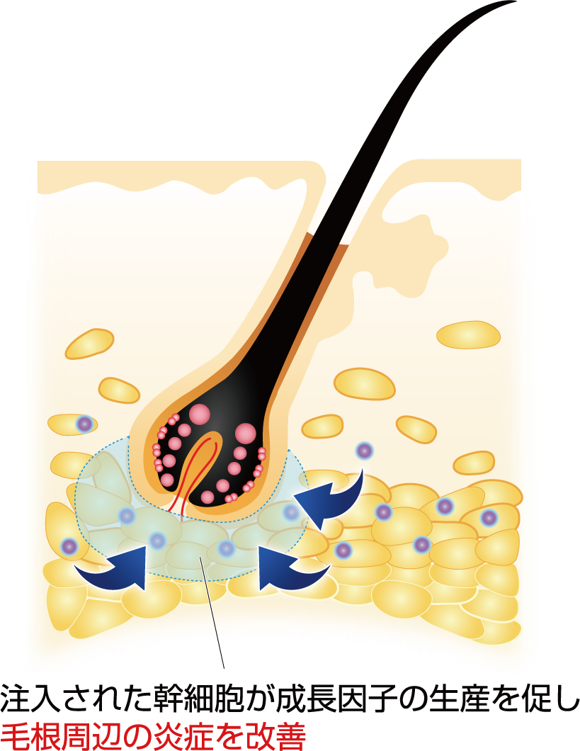 注入された幹細胞が成長因子の生産を促し毛根周辺の炎症を改善
