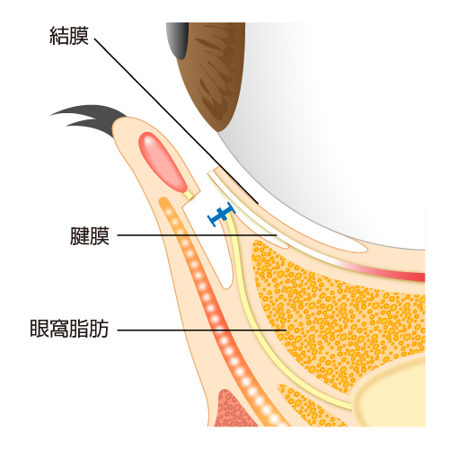たれ目形成 グラマラスライン 下眼瞼下制術 二重まぶた 目頭切開 涙袋 眼瞼下垂 美容整形 美容外科 美容皮膚科なら聖心美容クリニック