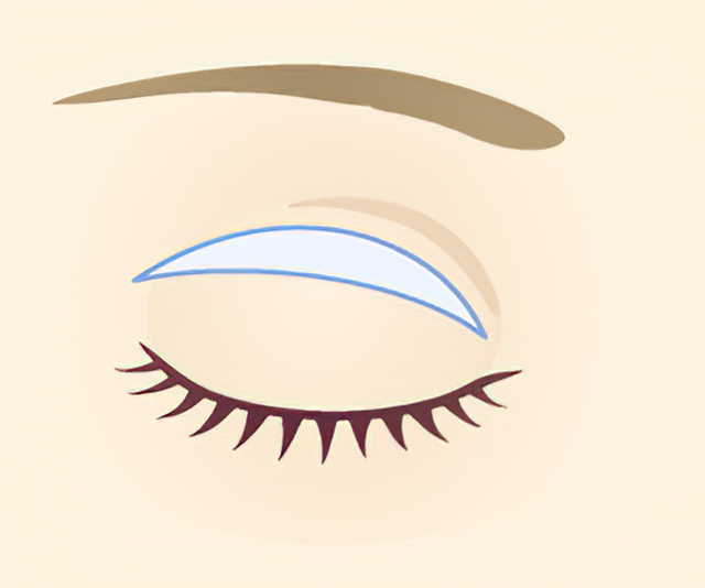 重瞼線部切開法 目のくま たるみ取り 美容整形 美容外科 美容皮膚科なら聖心美容クリニック