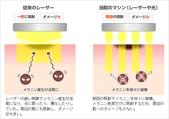 従来のレーザー 一気に照射 ダメージ大 レーザーの鋭い刺激でメラニン産生が活発になり、元に戻ったり、悪化したりしていた。周辺の肌にも照射し、ダメージが大きい。 当院のマシン(レーザーや光) 数回の照射 ダメージ小 数回の照射でメラニンを徐々に破壊。メラニン色素だけに照射するため、周辺の肌へのダメージも少ない。