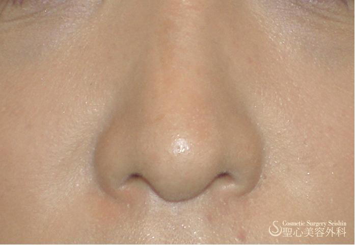 鼻の毛穴 カーボンピーリング 症例写真 美容整形 美容外科なら聖心美容クリニック