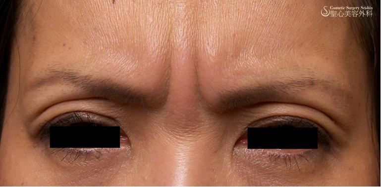 眉間 凹み目 ボトックス P Prp 症例写真 美容整形 美容外科なら聖心美容クリニック