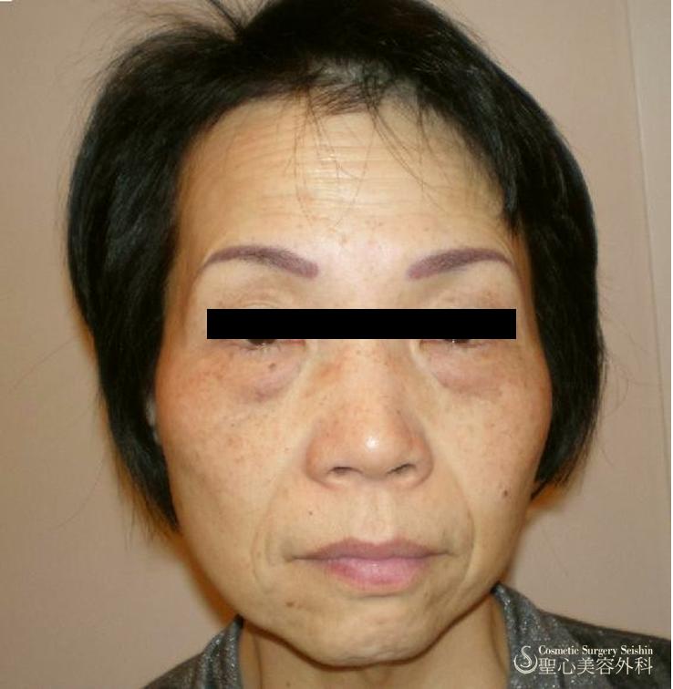 50歳代女性 目の下の弛み取り 脱脂 糸リフト8本による頬の引き上げ 症例写真 美容整形 美容外科なら聖心美容クリニック
