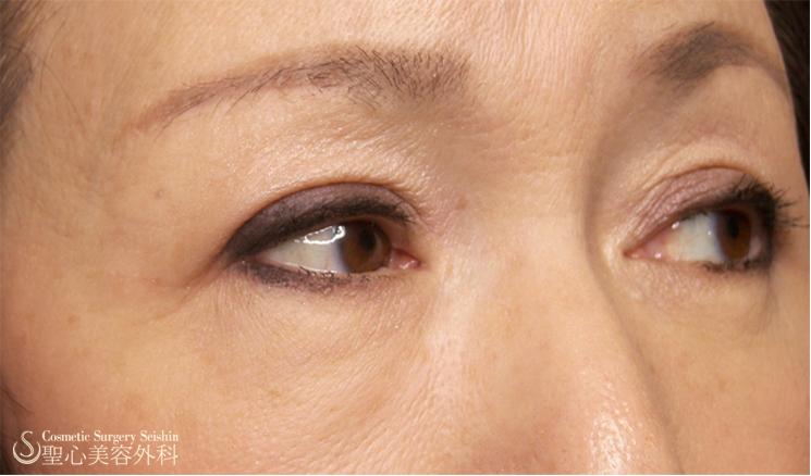 眉毛下切開術で三角目の改善 症例写真 美容整形 美容外科なら聖心美容クリニック