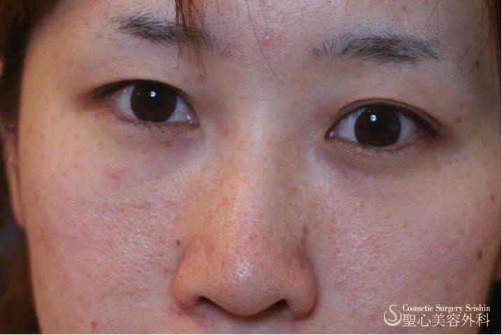 鼻プロテーゼ 症例写真 美容整形 美容外科なら聖心美容クリニック