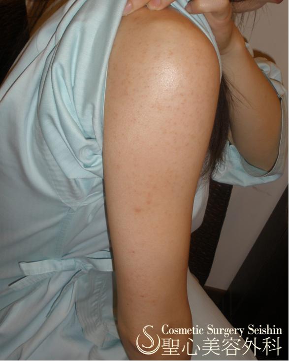 毛孔性苔癬 腕のぶつぶつ 症例写真 美容整形 美容外科なら聖心美容クリニック
