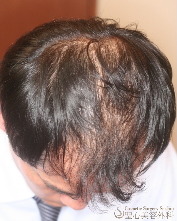 30代男性 頭頂部の薄毛 グロースファクター再生療法 プロペシア ロノテン リアップx5 症例写真 美容整形 美容外科なら聖心美容クリニック