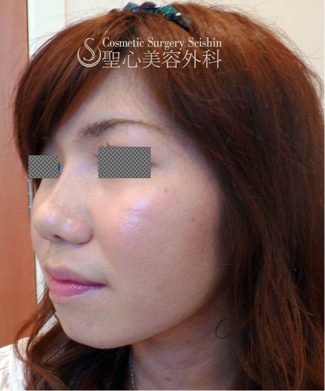 歳代女性 鼻の整形 鼻尖縮小 鼻先を細く 隆鼻術 シリコンプロテーゼ 症例写真 美容整形 美容外科なら聖心美容クリニック