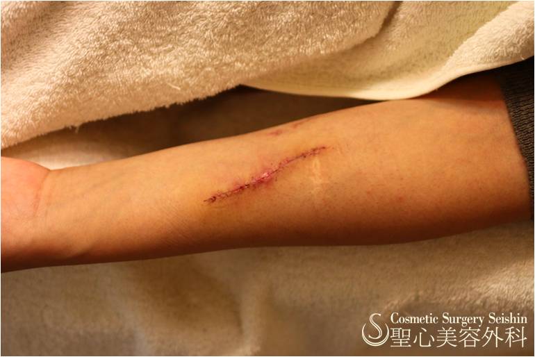 【20代女性・リストカット跡】傷痕修正（３ヶ月後） After 