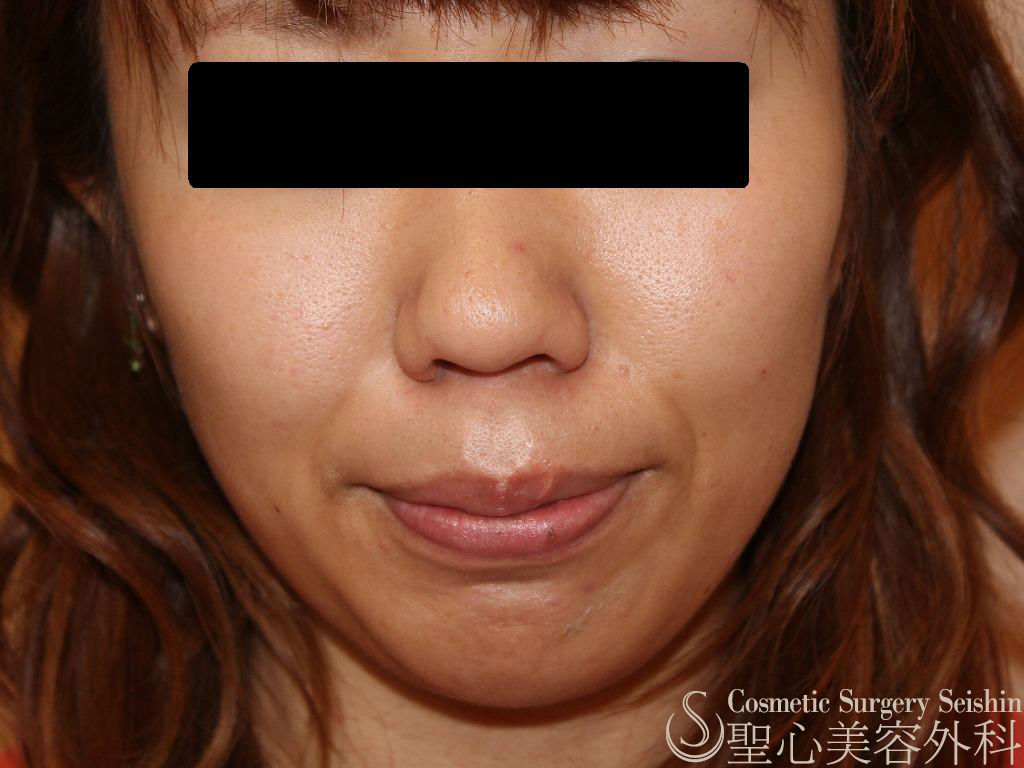 代女性 たるみ ほうれい線 プレミアムprp皮膚再生療法 症例写真 美容整形 美容外科なら聖心美容クリニック