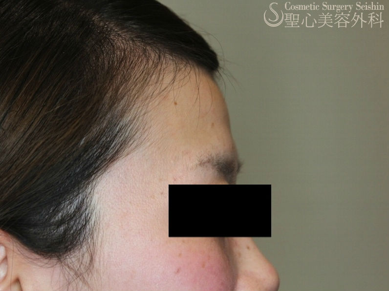 代女性 プレミアムprp皮膚再生療法 おでこを丸くなだらかに 症例写真 美容整形 美容外科なら聖心美容クリニック