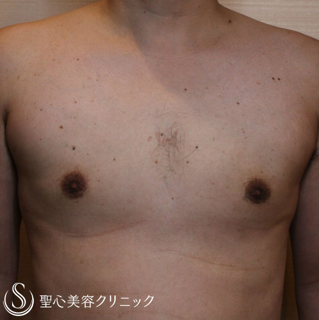 【30代男性・女性化乳房】乳腺切除・脂肪吸引（1ヶ月後） After 