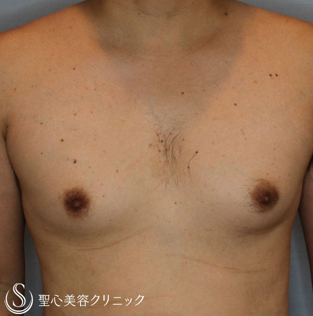 【30代男性・女性化乳房】乳腺切除・脂肪吸引（1ヶ月後） Before 