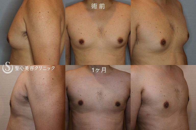 【30代男性・女性化乳房】乳腺切除・脂肪吸引（1ヶ月後） After 