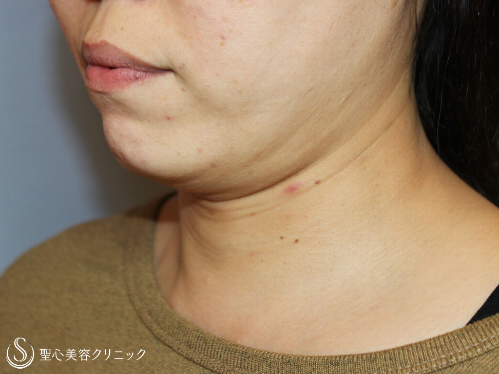 30代女性 あご下 首のたるみ取り ネックリフト 術後1ヶ月 症例写真 美容整形 美容外科なら聖心美容クリニック