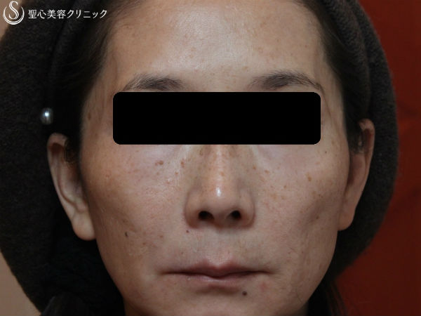 50代女性 こめかみと頬の改善 プレミアムprp 症例写真 美容整形 美容外科なら聖心美容クリニック