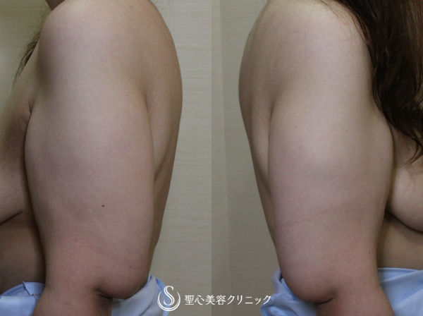 代女性 二の腕のたるみ取り 脂肪吸引 皮膚切除 症例写真 美容整形 美容外科なら聖心美容クリニック