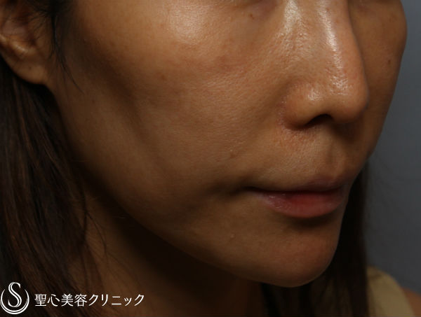 40代女性 頬のコケ改善 頬 目の下プレミアムprp 症例写真 美容整形 美容外科なら聖心美容クリニック