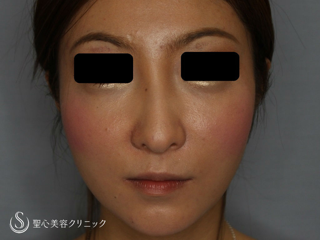 【30代・女性　こめかみ、目の下、頬のくぼみ】脂肪注入（術後2ヶ月） After 