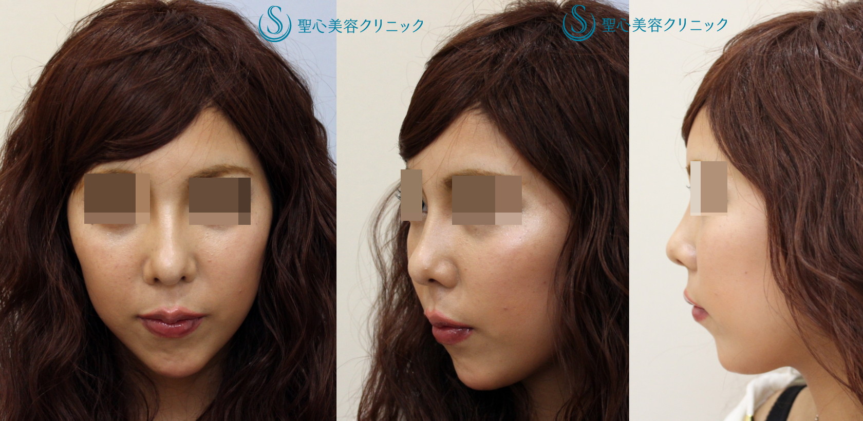 代女性 上向きの鼻を治してｅラインを整えたい 鼻尖 鼻柱耳介軟骨移植 1ヶ月後 症例写真 美容整形 美容外科なら聖心美容クリニック