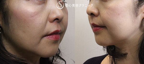 40代女性 頬から口元のたるみ ウルセラシステム 頬の輪郭注射 1 5ヶ月 症例写真 美容整形 美容外科なら聖心美容クリニック