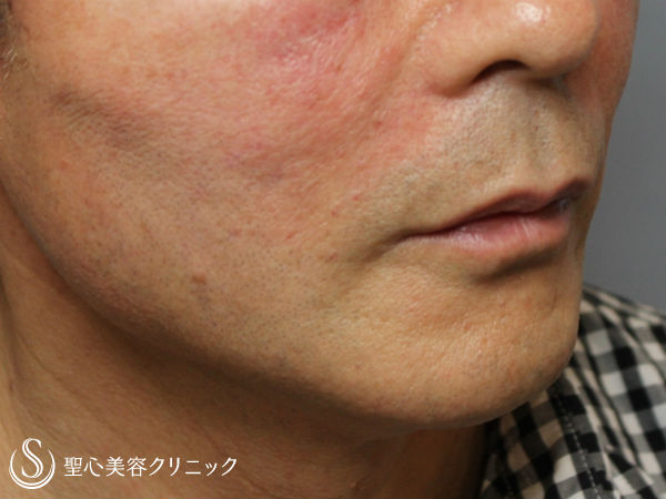 50代男性 頬のたるみとほうれい線のシワを改善 アンカーリフト プレミアムprp 施術直後 症例写真 美容整形 美容外科なら聖心美容クリニック