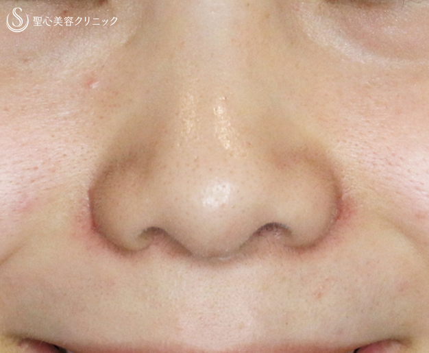 代女性 笑顔で広がる小鼻にも 小鼻縮小術 A法 2ヶ月後 症例写真 美容整形 美容外科なら聖心美容クリニック