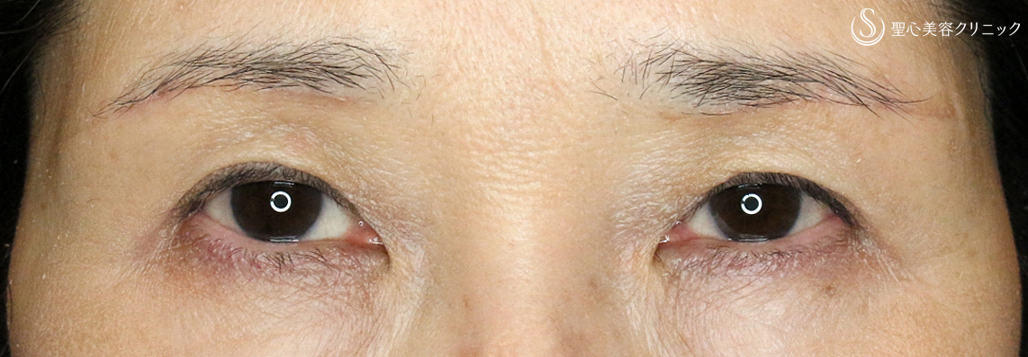 60代女性 まぶたのタルミ 三角目 眉下リフト 術後1ヶ月 症例写真 美容整形 美容外科なら聖心美容クリニック