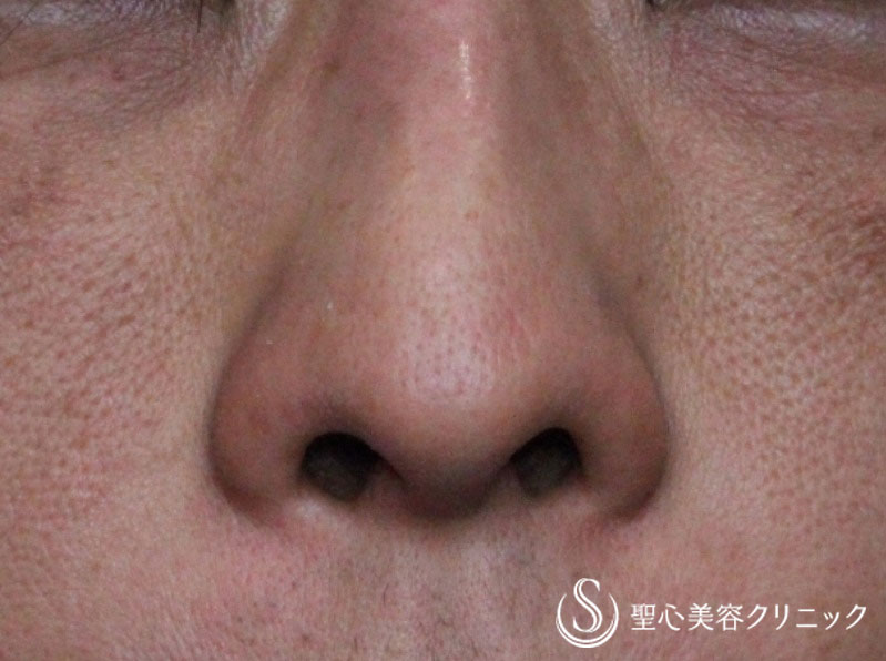 40代男性 鼻の穴を目立たなく 小鼻縮小術 術後1ヶ月 症例写真 美容整形 美容外科なら聖心美容クリニック