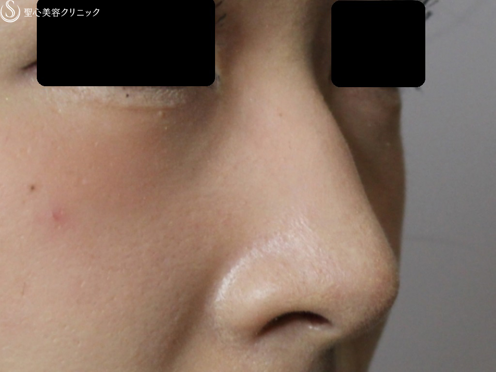 40代女性 綺麗な鼻筋に 鼻のヒアルロン酸 クレヴィエル 注入直後 症例写真 美容整形 美容外科なら聖心美容クリニック