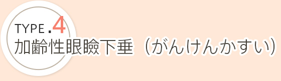 加齢性眼瞼下垂（がんけんかすい）