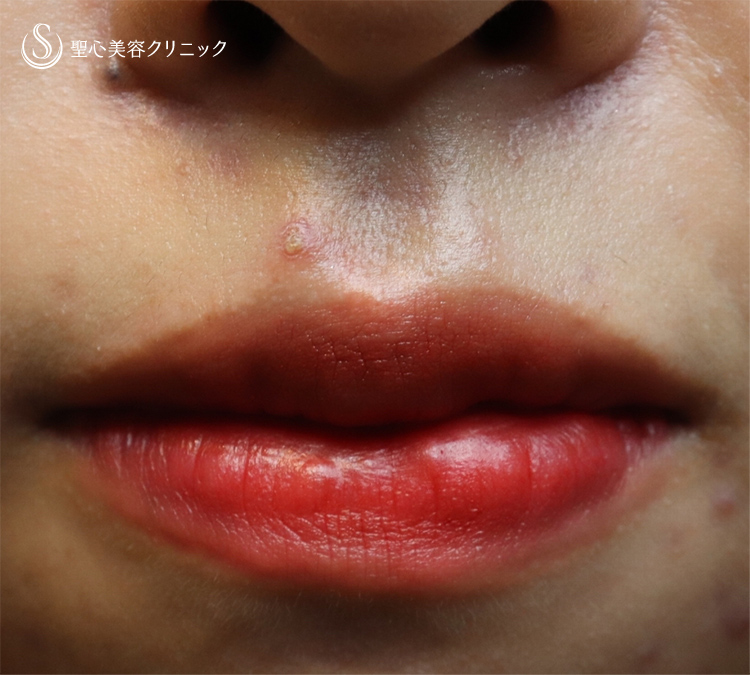 代女性 唇を薄く 口唇縮小術 術後１ヶ月 症例写真 美容整形 美容外科なら聖心美容クリニック