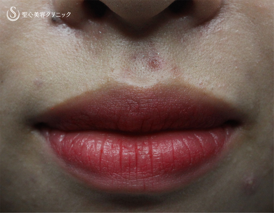代女性 唇を薄く 口唇縮小術 術後１ヶ月 症例写真 美容整形 美容外科なら聖心美容クリニック
