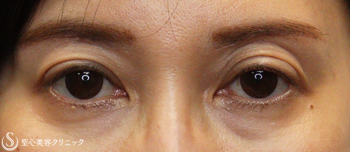 50代女性 目の開けやすく 切らない眼瞼下垂手術 眉下切開 1ヶ月後 症例写真 美容整形 美容外科なら聖心美容クリニック