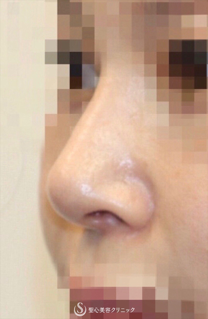 40代女性 美人鼻に 鼻中隔延長術 鼻尖形成術 耳介軟骨移植 術後2ヶ月 症例写真 美容整形 美容外科なら聖心美容クリニック
