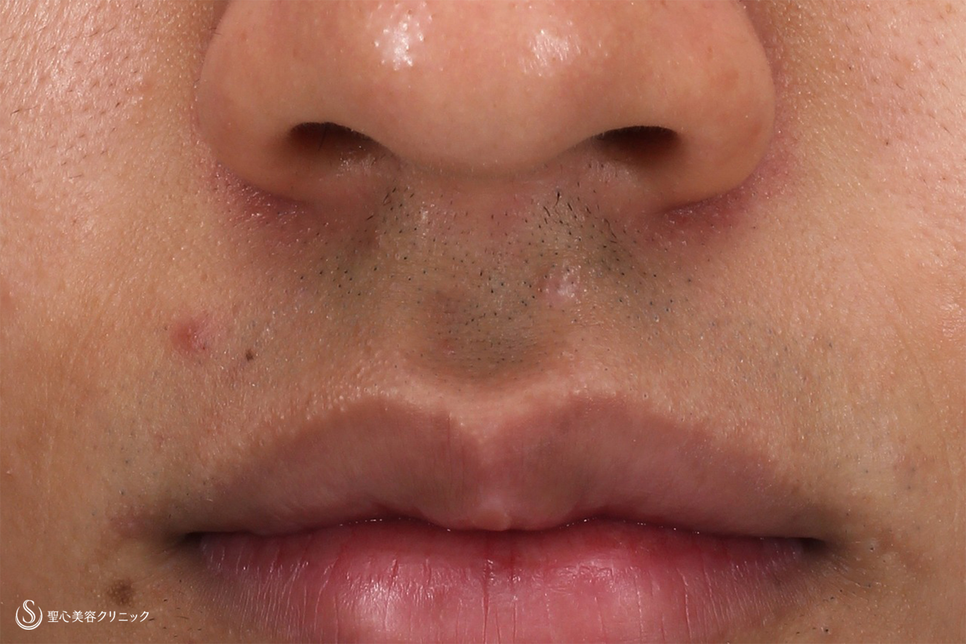 10代男性 鼻の下のホクロ 電気凝固法 8か月後 症例写真 美容整形 美容外科なら聖心美容クリニック