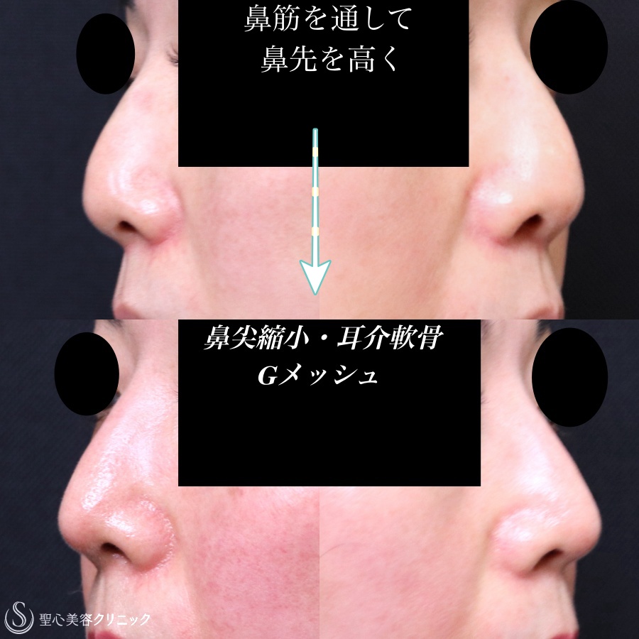 鼻形成術 = Aesthetic Rhinoplasty : 美容外科手術手技 - 健康/医学