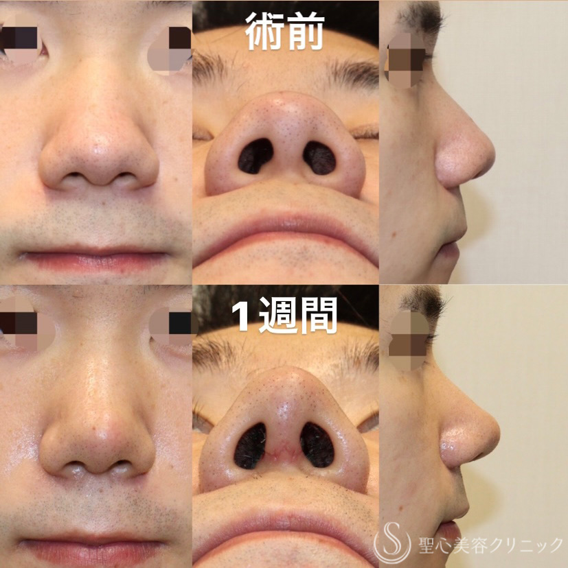 鼻形成術 Aesthetic Rhinoplasty 美容外科手術手技 健康 | sgcs.in