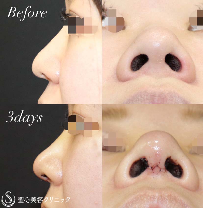 鼻形成術 = Aesthetic Rhinoplasty : 美容外科手術手技 - 健康/医学