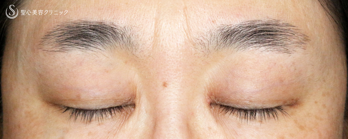 【40代女性・コンタクトレンズ下垂の第一選択】切らない眼瞼下垂+α法（4年後） After 