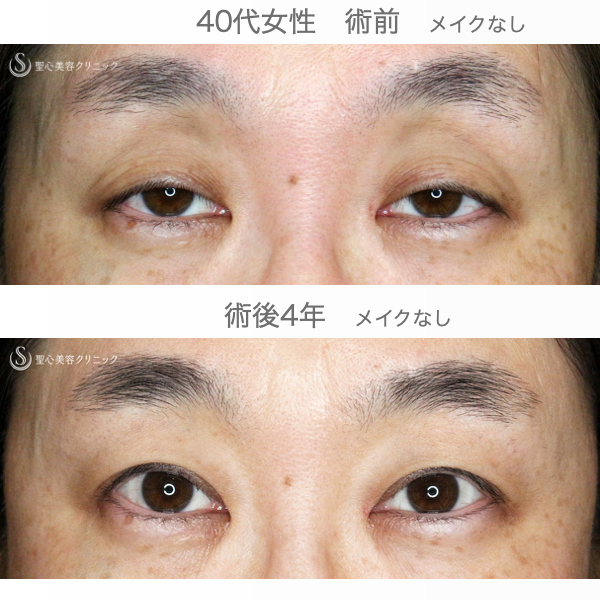 【40代女性・コンタクトレンズ下垂の第一選択】切らない眼瞼下垂+α法（4年後） After 