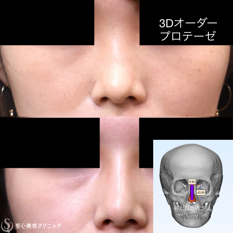 【20代女性・骨の曲線に合わせて作成】3Dオーダープロテーゼ隆鼻術（1年後） Before 