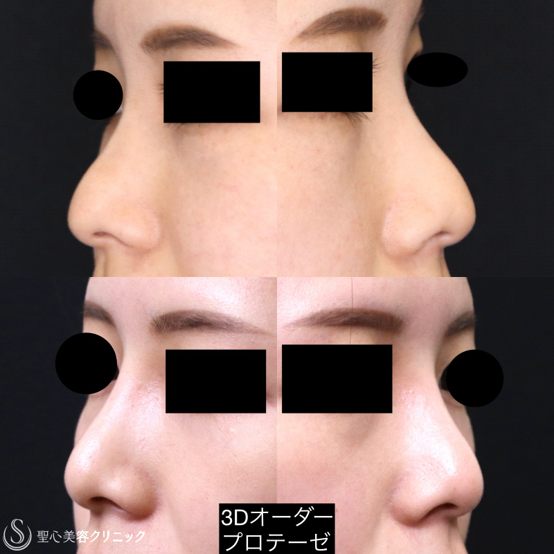 【20代女性・骨の曲線に合わせて作成】3Dオーダープロテーゼ隆鼻術（1年後） After 