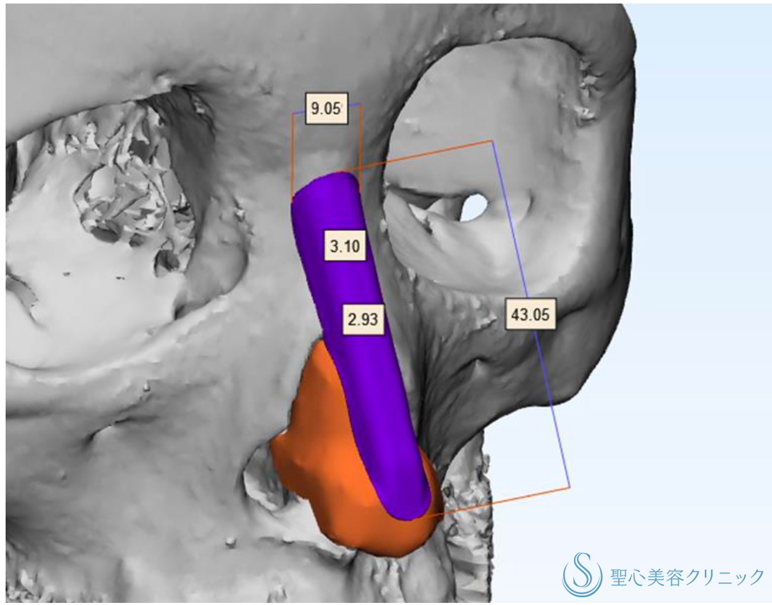 【20代女性・骨の曲線に合わせて作成】3Dオーダープロテーゼ隆鼻術（1年後） After 
