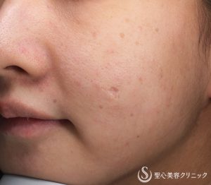 20代女性・凹んだ傷跡治療】ピコレーザー（PICOフラクショナル）（2回施術後） - 症例写真 - 美容整形、美容外科なら聖心美容クリニック