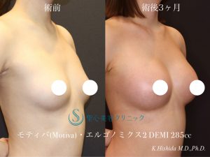 【20代女性・ナチュラルにしっかり大きくバストアップ！！美巨乳になりたい！！】ハイブリッド豊胸術（Motiva DEMI 285cc）（術後3ヶ月） After 