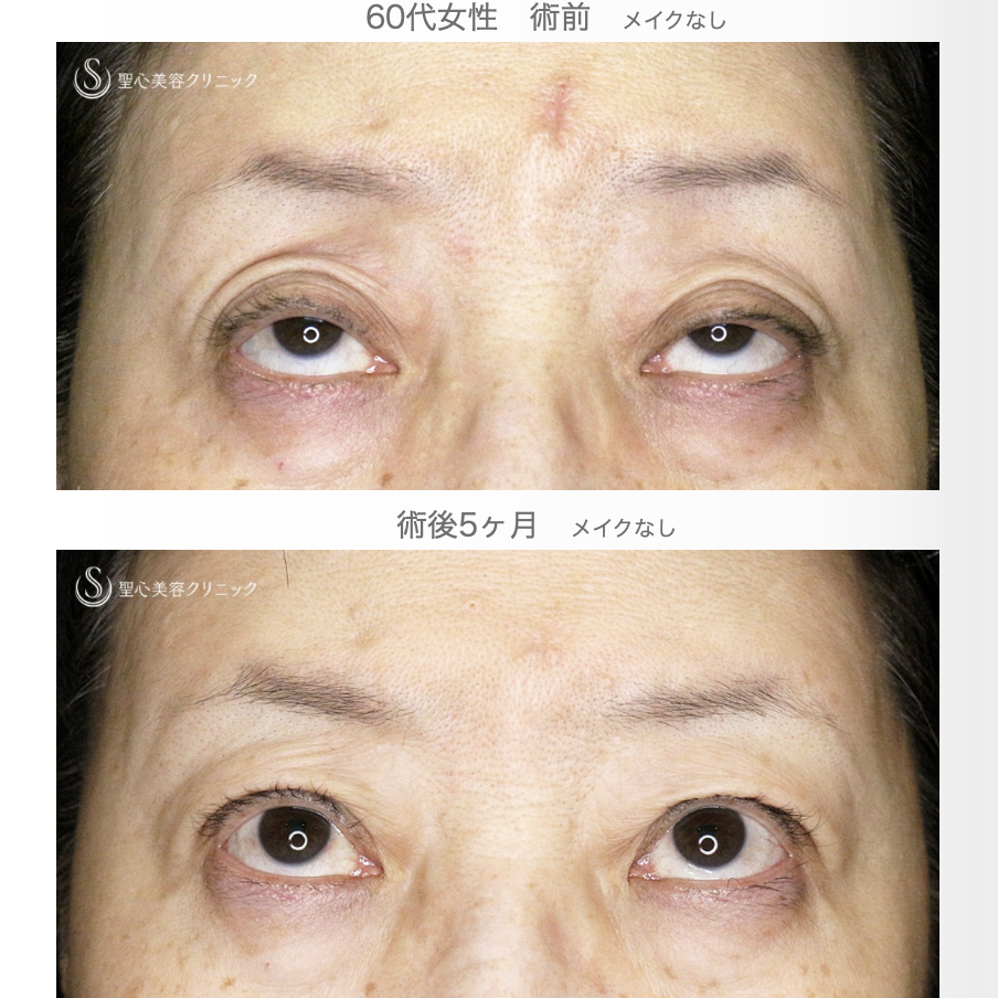 【60代女性・ハードコンタクトによる眼瞼下垂】切らない眼瞼下垂+α法（術直後〜5ヶ月後） After 