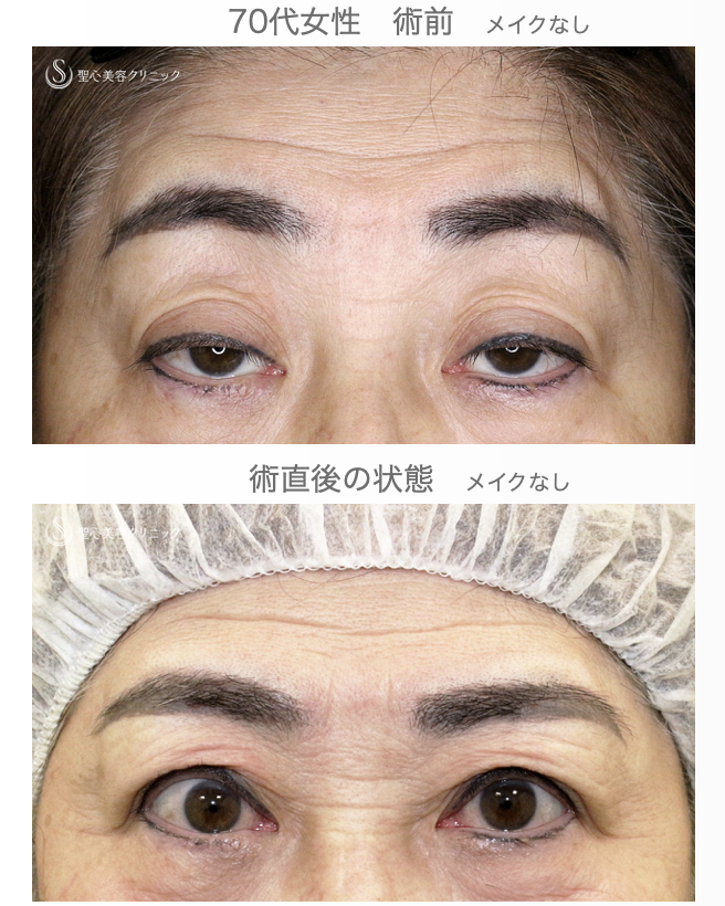 【70代女性・ハードコンタクトによる眼瞼下垂】切らない眼瞼下垂+α法 単独（術直後） After 